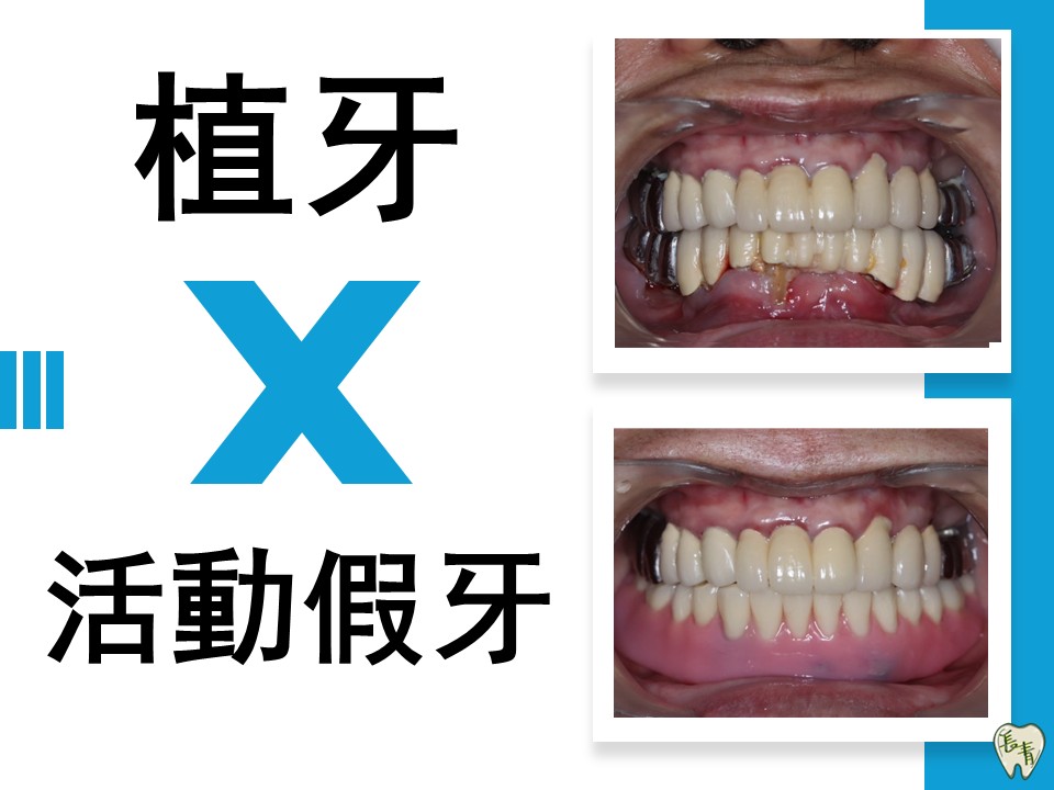 缺牙!但不想全口植牙怎麼辦呢?-長青牙醫診所【劉南佑醫師】