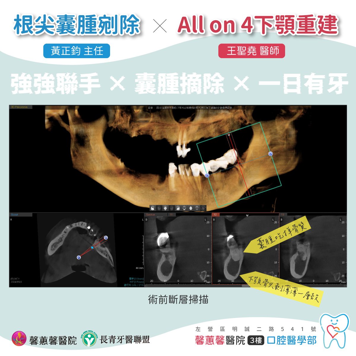 強強聯手x囊腫摘除x一日有牙